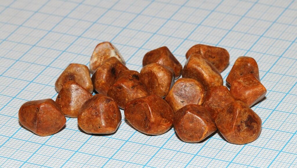 Cholesterol gallstones. Image source: wikipedia.org
