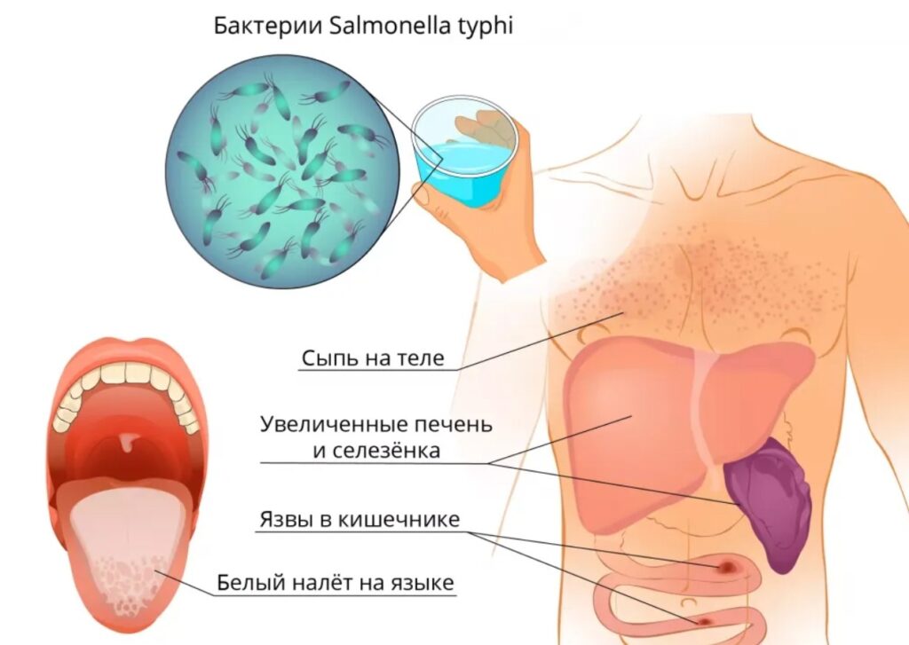 Почему брюшной тиф распространяются по всему миру. Симптомы брюшного тифа. Источник изображения: bigenc.ru. Symptoms of typhoid fever. Image source: bigenc.ru