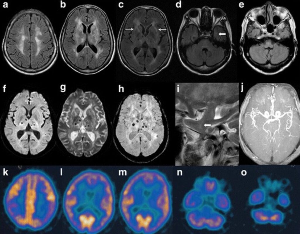What is fatal familial insomnia. MRI scan of a patient with fatal insomnia. Image source: wikipedia.org. What is fatal familial insomnia. MRI scan of a patient with fatal insomnia. Image source: wikipedia.org. Photo.