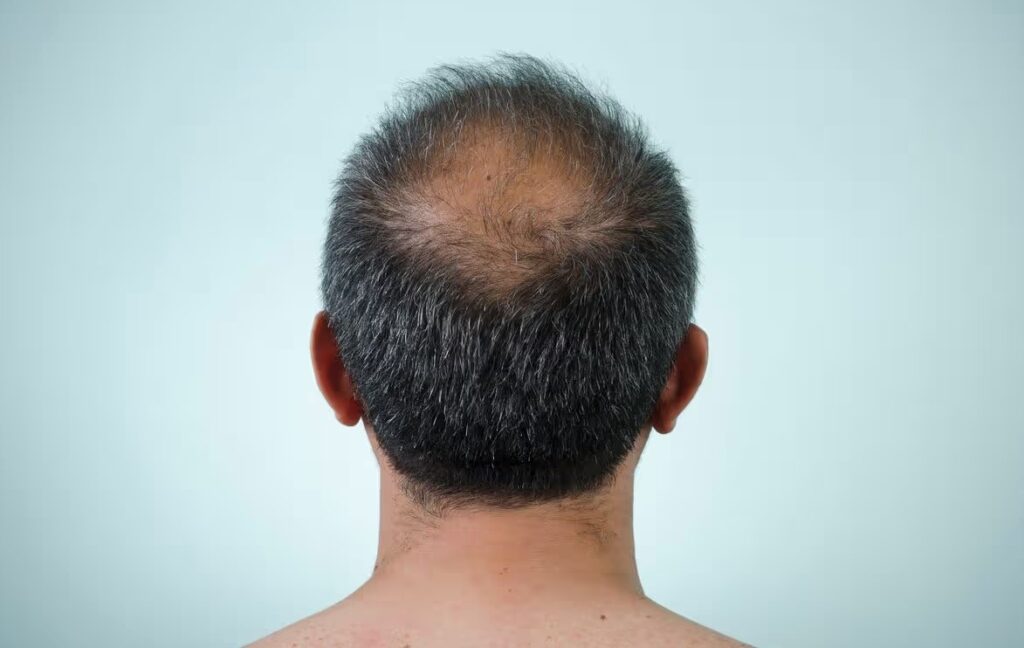 Baldness Defeated? Scientists Grew Living Hair for the First Time. Three types of cells, one Petri dish, and a little patience — this is what the potential future of fighting baldness looks like. Image source: sciencealert.com. Photo.