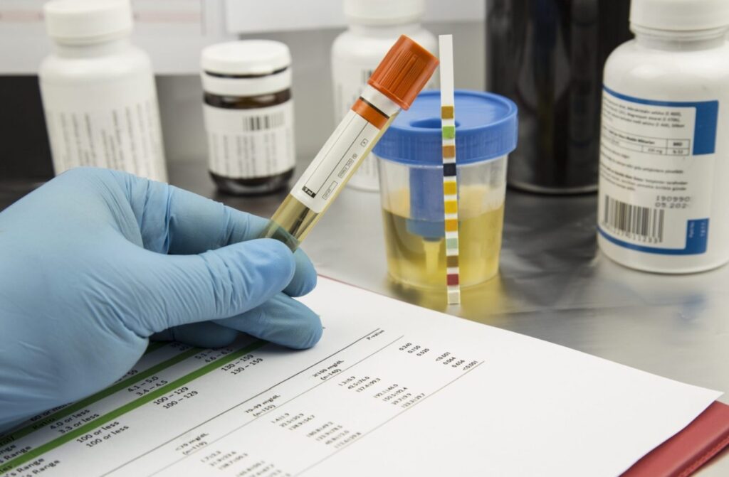 The shade of urine directly depends on the amount of water you drink. Photo.