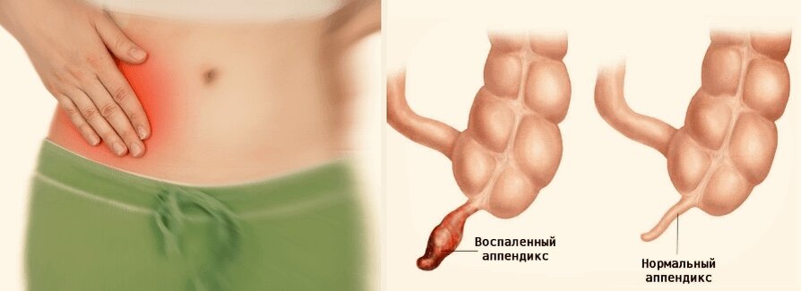 Can You Live Without an Appendix and How Dangerous Is Appendicitis. Pain in the lower right abdomen is a classic symptom of appendicitis. Image source: medicabil.com. Can You Live Without an Appendix and How Dangerous Is Appendicitis. Pain in the lower right abdomen is a classic symptom of appendicitis. Image source: medicabil.com. Photo.
