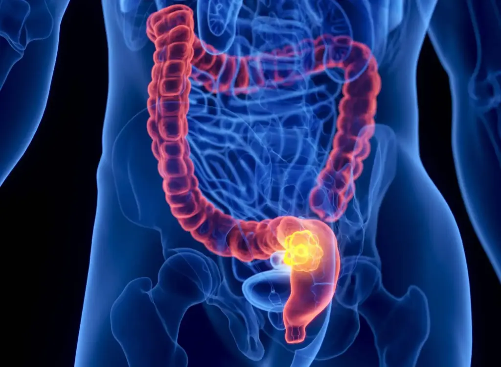 Scientists are sounding the alarm about colorectal cancer in young people. Photo.