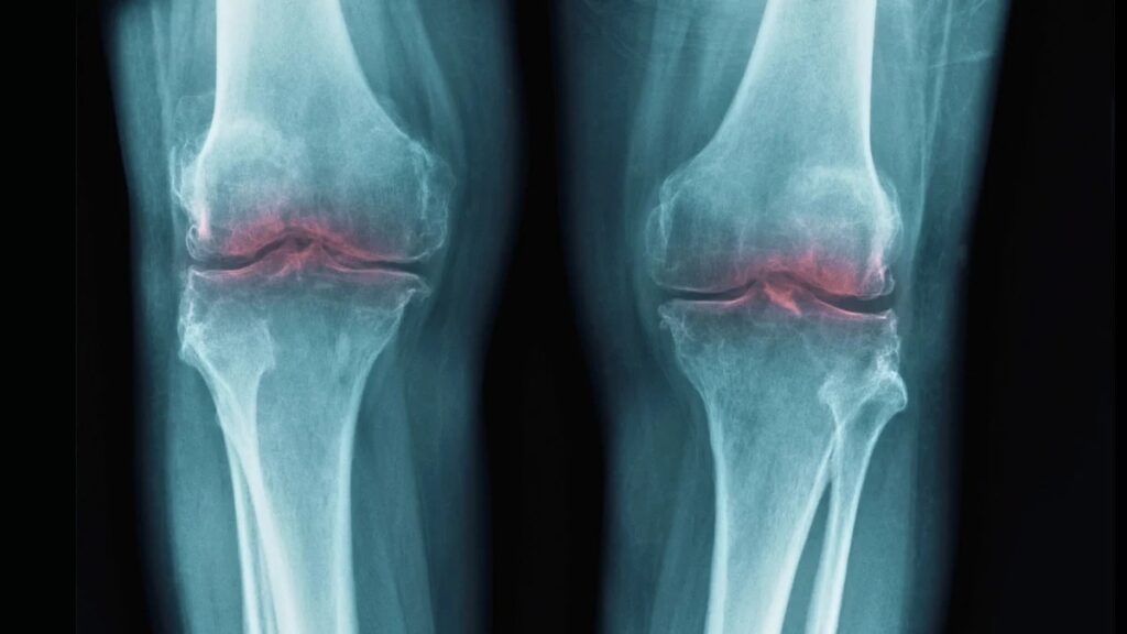 With age, joints can become stiff and painful, which may be a symptom of osteoarthritis. Photo.