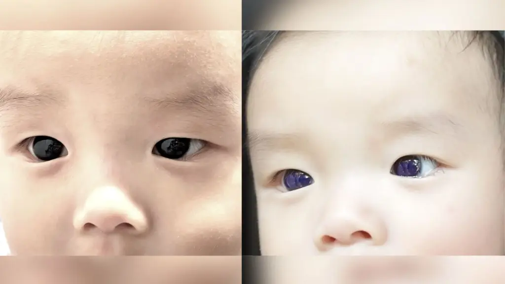 Shocking medical case: baby's eyes turned blue after COVID treatment. Photo.