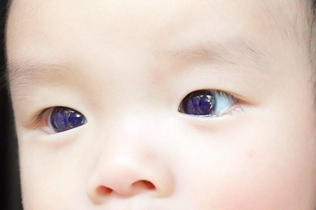 The baby's eye color changed after being prescribed an antiviral drug. Photo.