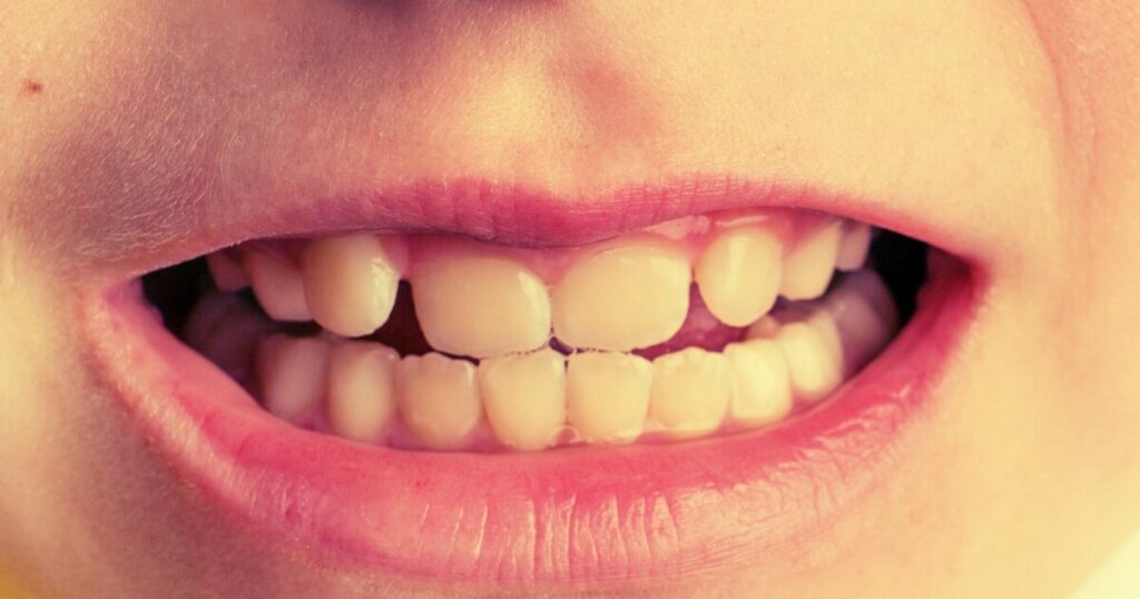 Silent epidemic: why every fourth child's teeth are breaking