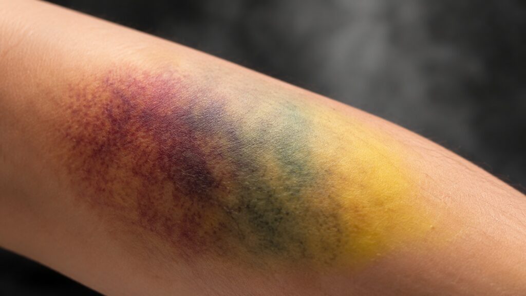 The appearance and disappearance of a bruise is a whole science hidden from our eyes. Photo.