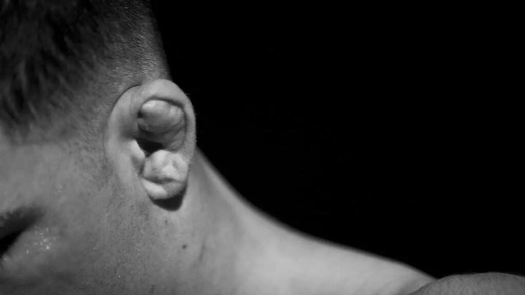 A boxer's ear. Constant friction and blows to the head during fighting damage blood vessels in the ear. Photo.