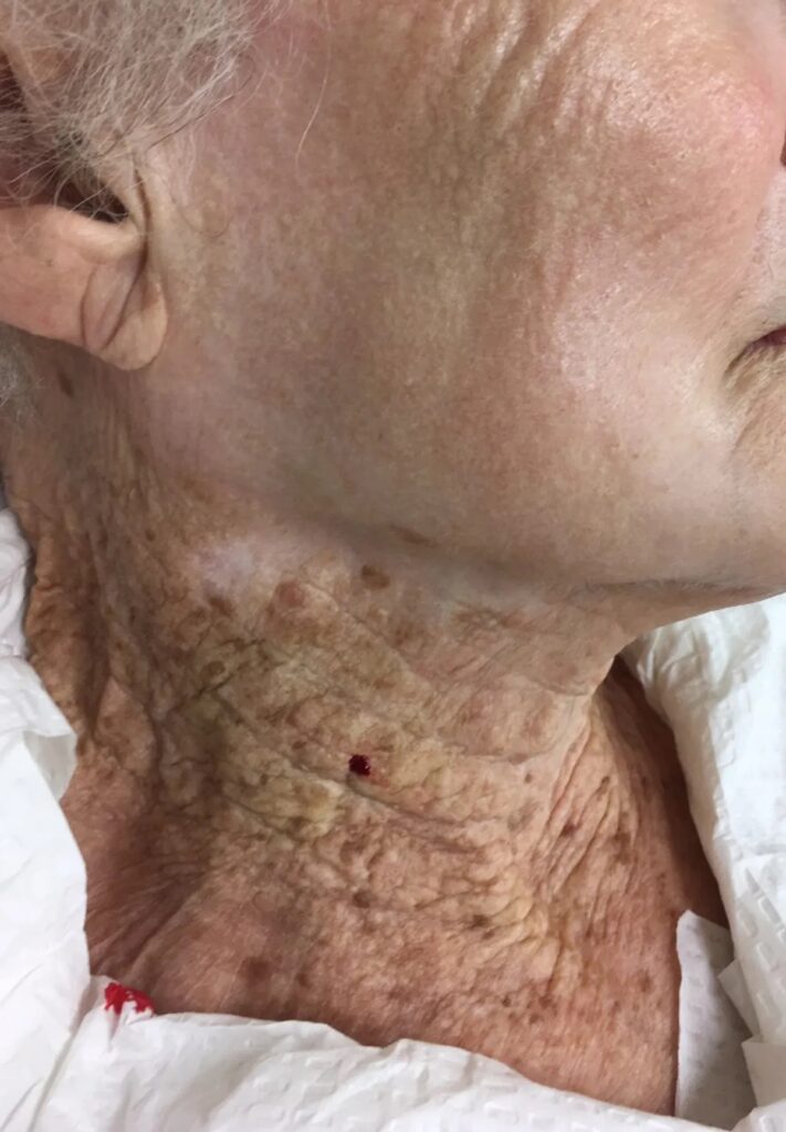 Cheek and neck of a 92-year-old woman who used UV-protective moisturizers on her face for over 40 years but not on her neck. Photo.