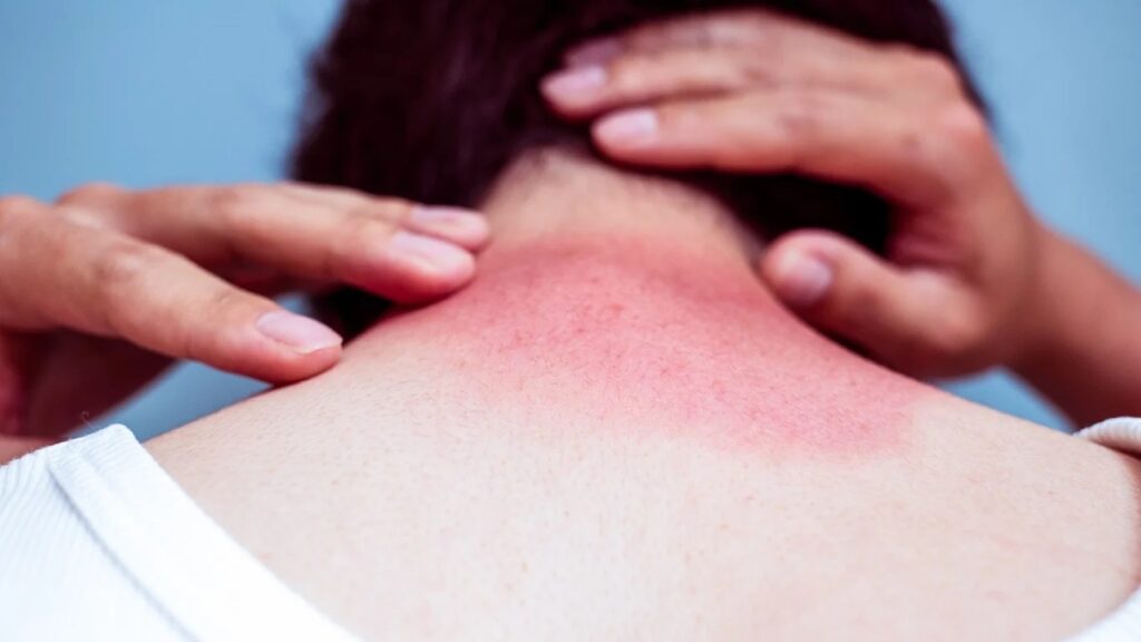 Why dermatologists warn about the danger of sun exposure for neck skin. Photo.