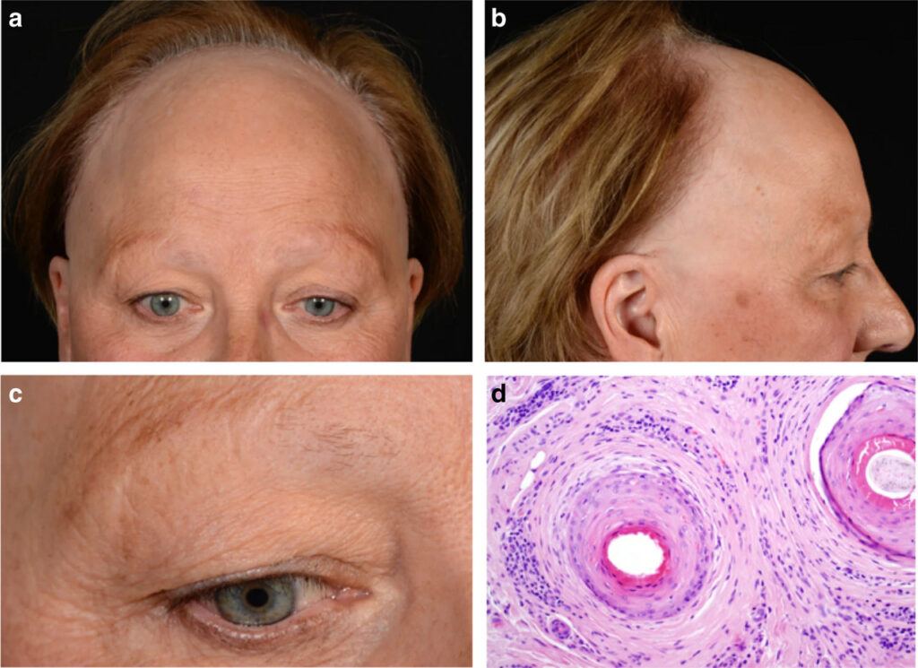 If scarring alopecia is suspected, it is important to see a doctor as soon as possible to stop the process