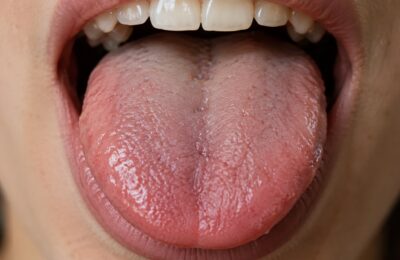Tongue Bacteria Linked to Faster Reaction Times in a Small Study of Healthy Adults